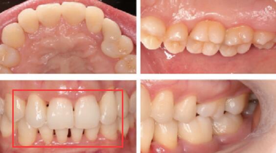 重度牙周炎+Ⅲ度深覆合，做牙齿矫正和修复联合治疗的实例