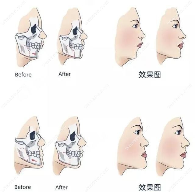正颌手术后脸型改变图