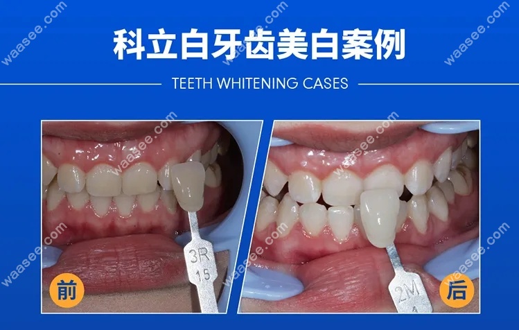 牙齿美白的病例