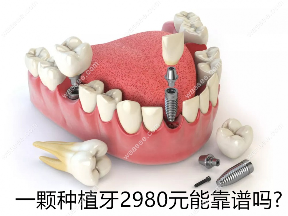 一颗种植牙2980元能靠谱吗?