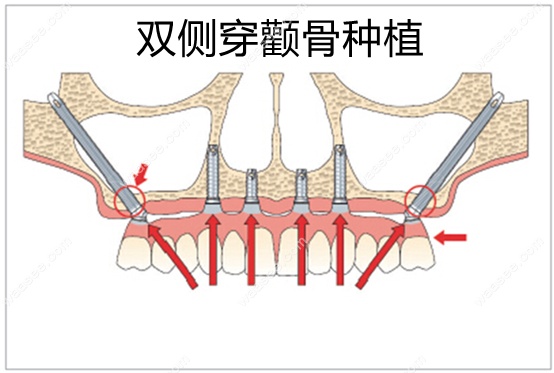 什么是穿颧骨穿翼板种植牙技术?解析双侧穿颧穿翼种植流程