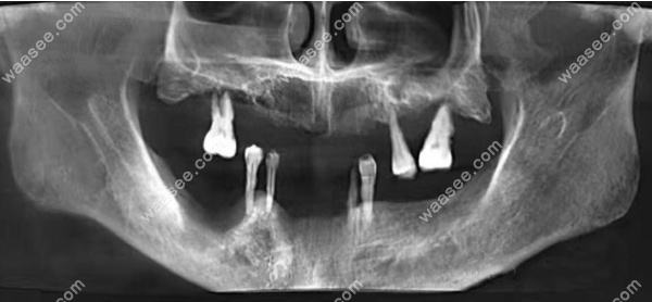 合肥新安口腔医院种植牙病例