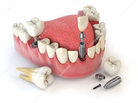 2021北京种植牙多少钱一颗?北京牙科医院种植牙收费标准下调