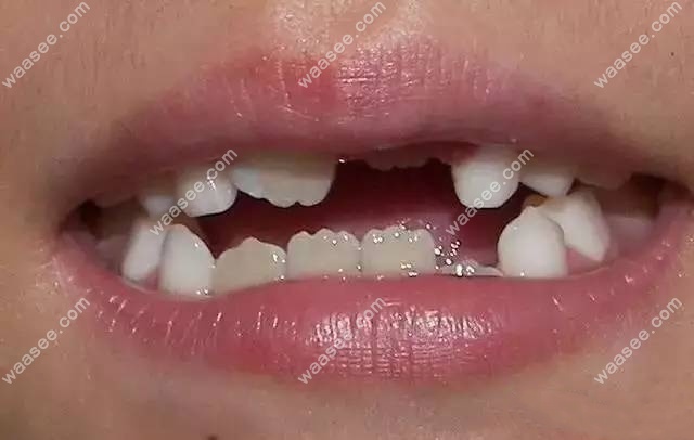 锯齿牙是什么原因造成的