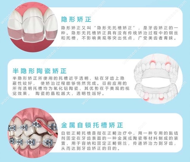 美植口腔牙齿矫正有几种方式？.jpg