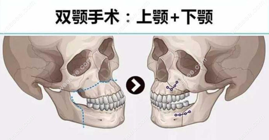 上海薇琳齿科的正颌项目