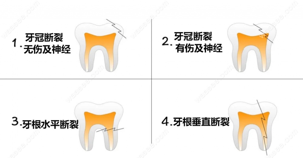 牙齿纵裂和横裂的区别