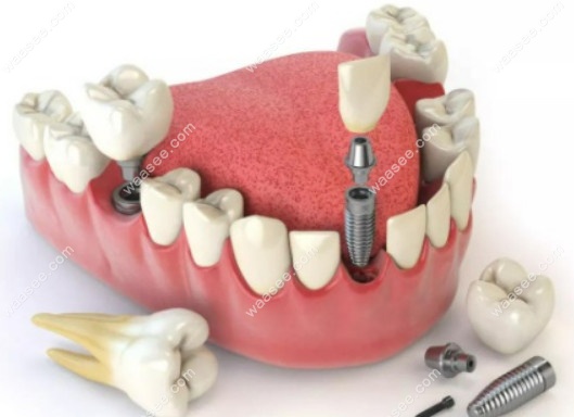 三亚鼎点口腔的种植牙技术