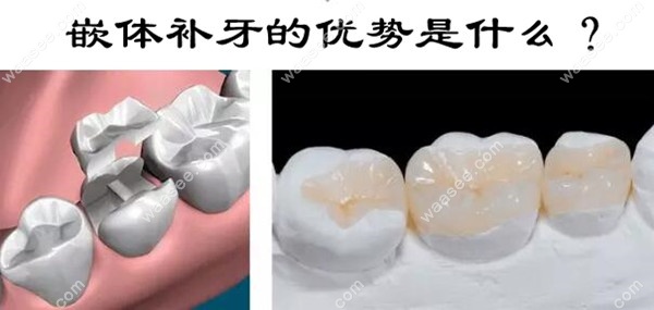 嵌体补牙的优势和适应症
