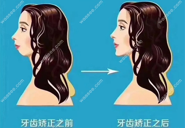 凸嘴矫正前后对比