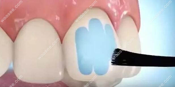 固化牙齿和托槽上的粘接剂