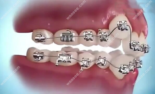 矫正牙齿安装金属牙套的过程图解