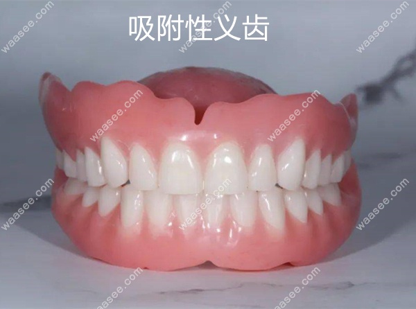 BPS吸附性义齿