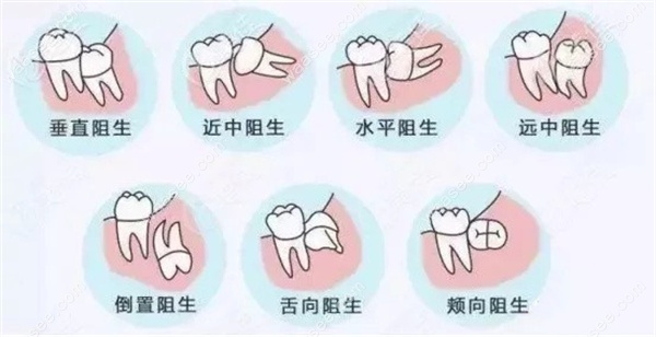 智齿的种类