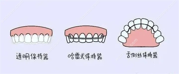 牙齿矫正保持器的种类及优缺点是什么,解答如何正确选择