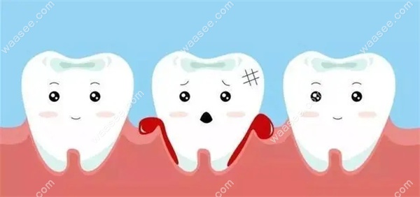 患有牙周炎可以矫正吗?可以,但建议等牙周炎稳定后再矫正哦