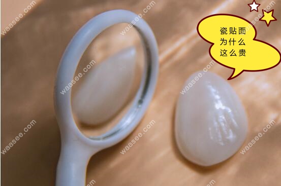 全瓷牙齿贴面为什么这么贵