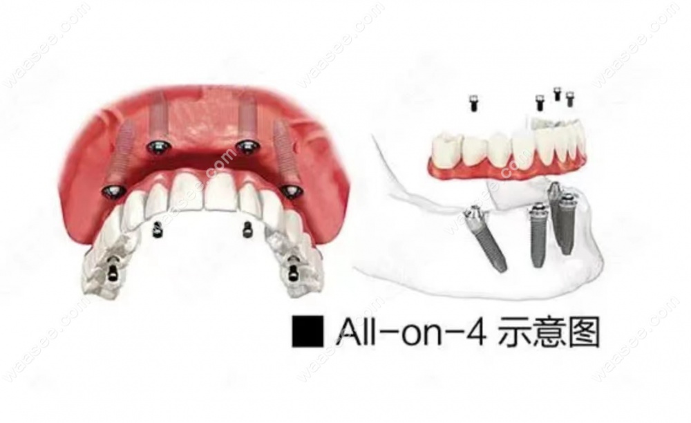数字化种植牙的介绍流程