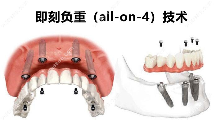 武汉咿呀口腔3D数字化种植牙技术厉害