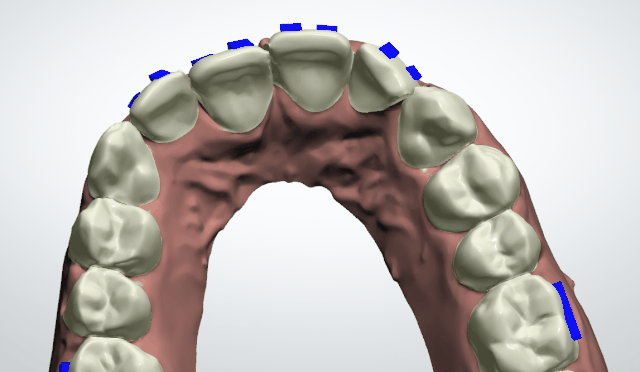 牙齿正畸方案模拟设计