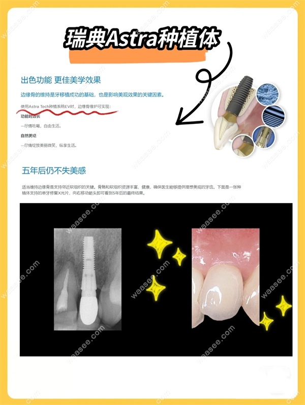 瑞典种植牙多少钱一颗