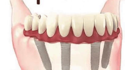 ALL-ON-4种植牙技术