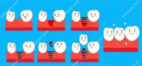 种植牙的流程图waasee.com