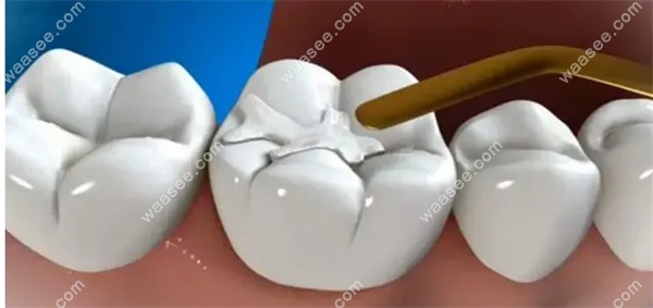 补牙材料150/200/300/400元的区别