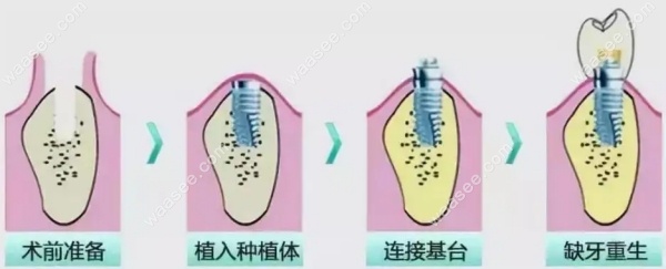 种植牙流程示意图
