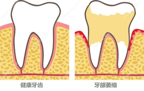 解答牙龈萎缩、牙槽骨吸收是否还可以装全口义齿