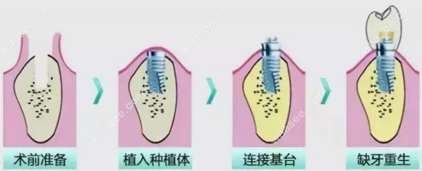 瑞士ITI种植体与sic植体价格是多少