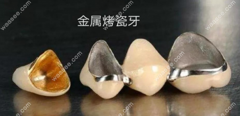 金属烤瓷牙冠示意图waasee.com