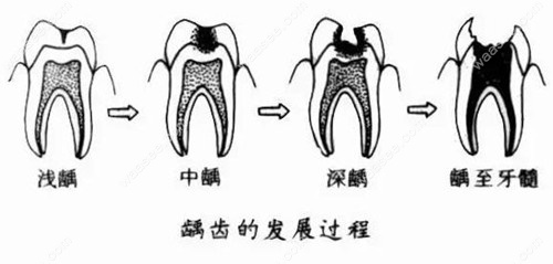 儿童龋齿程度waasee.com