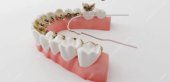舌侧矫正示意图waasee.com