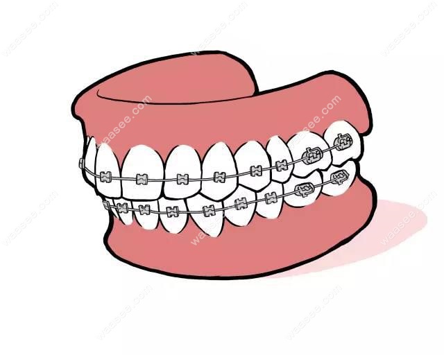 进口自锁托槽矫正价格waasee.com