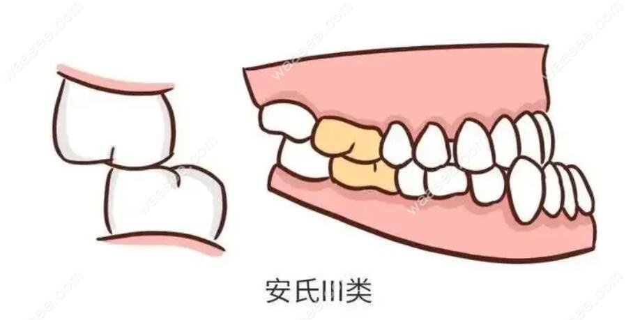 安式反颌错颌畸形