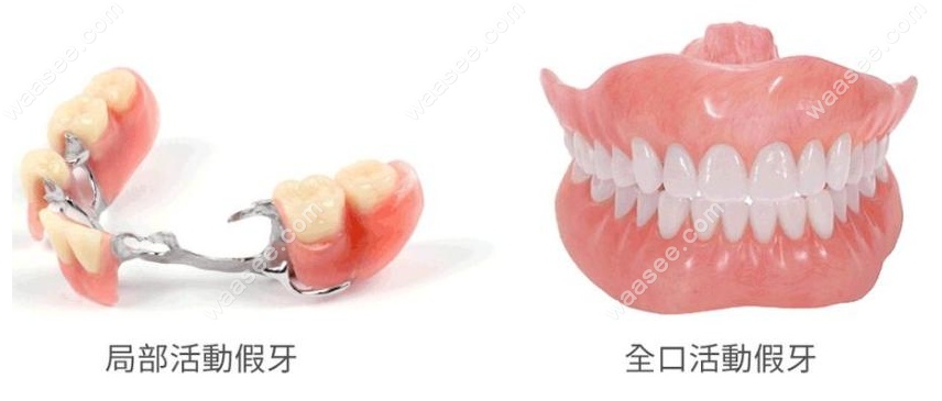 老年人做活动假牙修复缺牙好www.waasee.com吗