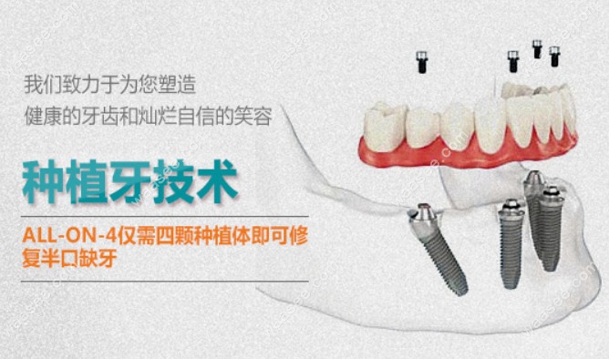 玉溪舒尔口腔的Allon4种植牙技术