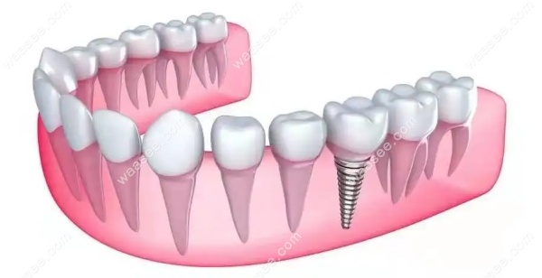 深圳瑞尔齿科可开展种植牙项目