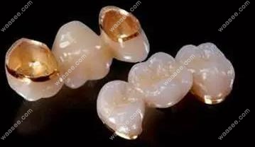 烤瓷牙与全瓷牙waasee.com