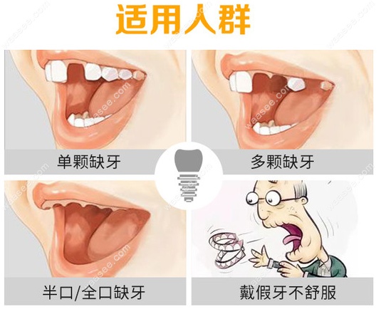 呼和浩特种植牙多少钱一颗2023