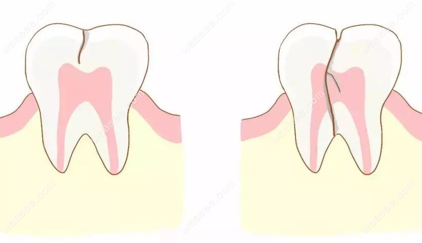 牙隐裂的主要症状是什么waasee.com