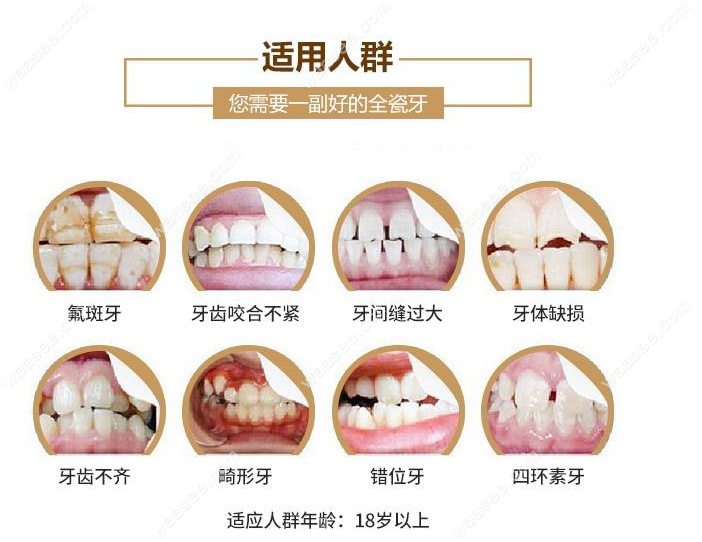 国产爱尔创全瓷牙的价格及优缺点