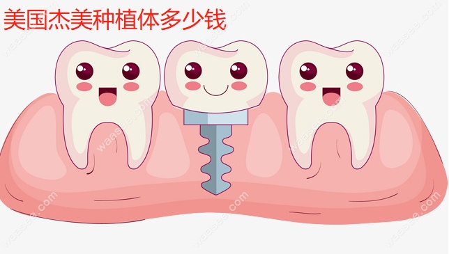 美国杰美种植体多少钱一颗www.waasee.com