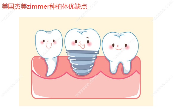 美国杰美种植体优缺点