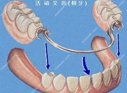 <!--<i data=20240703-sp></i>-->镶活动假牙价格