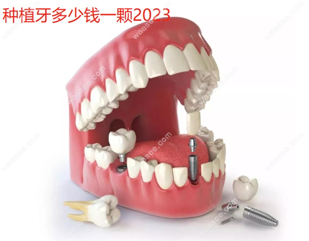 种植牙多少钱一颗2023