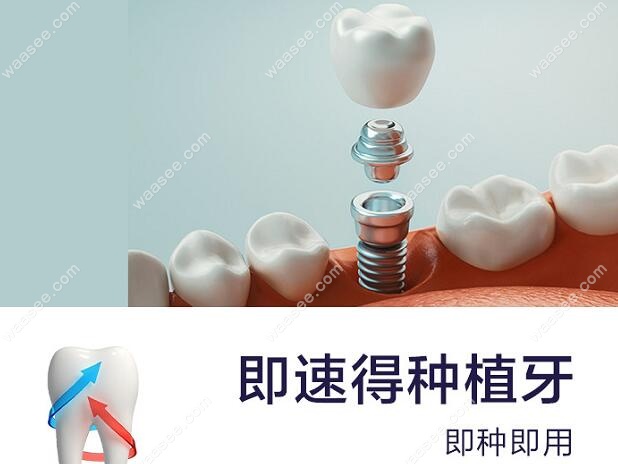 咸阳单颗种植牙医疗服务费不超过4300元