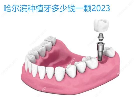 哈尔滨种植牙多少钱一颗2023