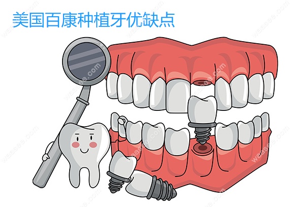 美国百康种植牙优缺点